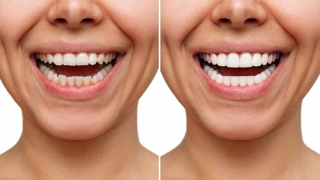 Contact Aspire White for teeth whitening services – Get in touch with Bolton today