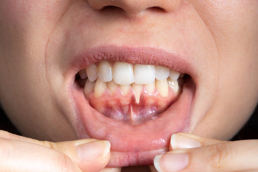 Preparing for teeth whitening with receding gums Bolton