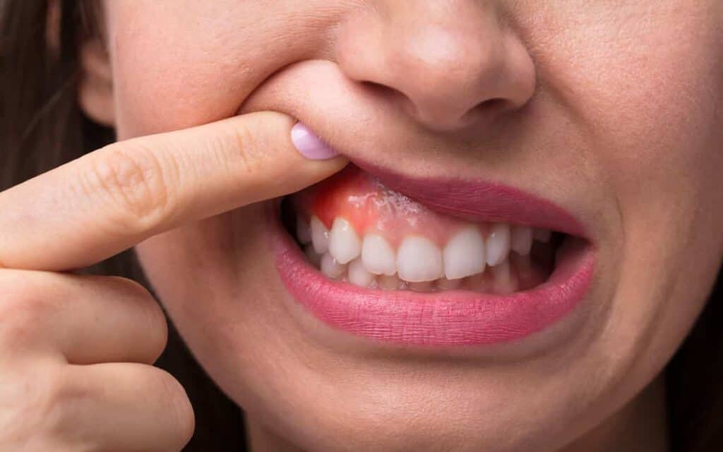 What is Receding Gums Bolton?