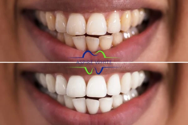 Aspire White customer before and after Bolton results.