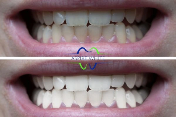 1 hour laser teeth whitening before and after results Bolton