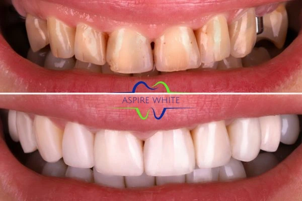Yellow teeth results - 1 hour whitening before and after results Bolton