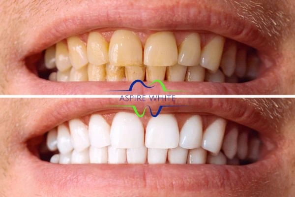 Get noticeable whiter smile in just one hour! Book your teeth whitening treatment Bolton today!