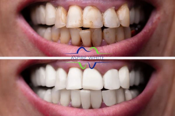 Before and after results of laser teeth whitening Bolton Book in online today!