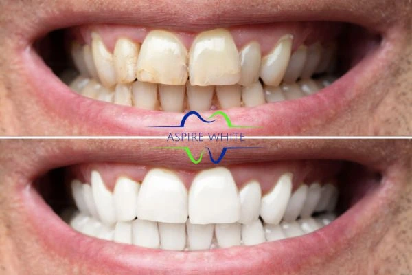 Achieve a radiant smile with professional laser teeth whitening Bolton